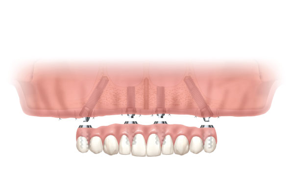 Model of All-on-4 placement in the mouth