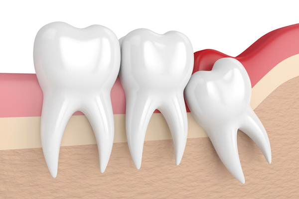 Illustration of an impacted wisdom tooth. Illustration of an impacted wisdom tooth.